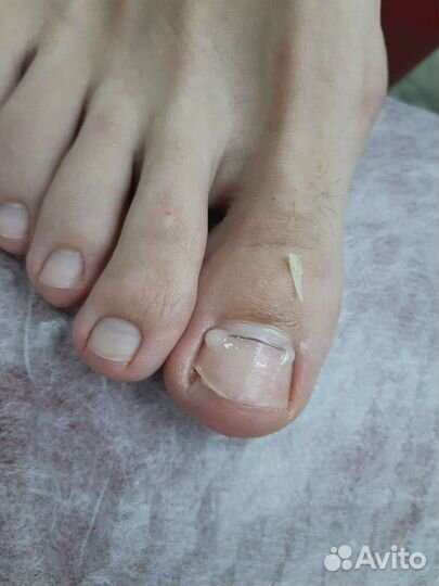 Медицинский педикюр подолог