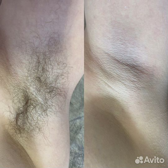 Шугаринг: глубокое бикини