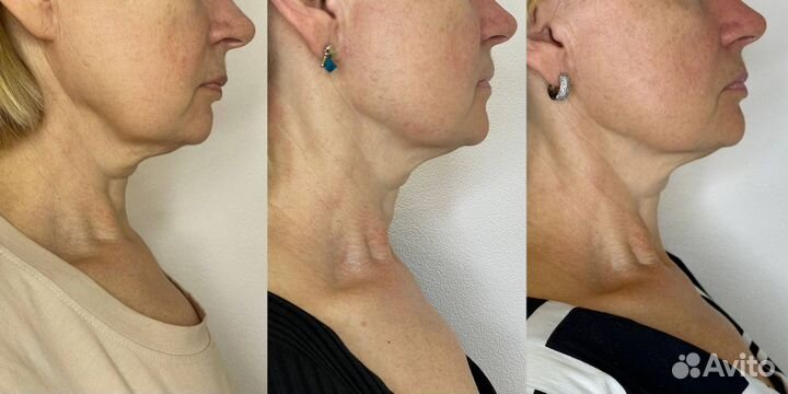 RF-лифтинг (подтяжка)