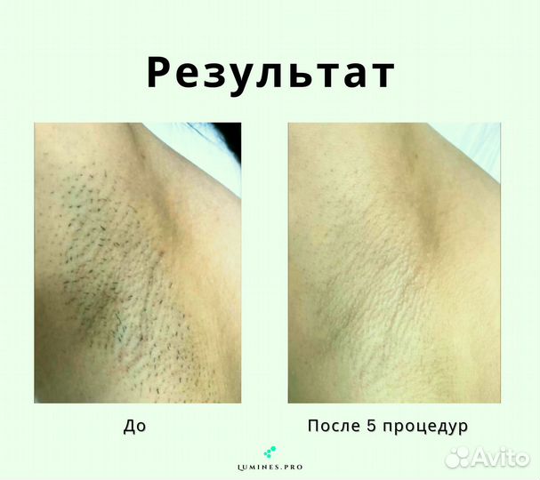 Диодный лазер Lumines-M Макс-Ван 1200