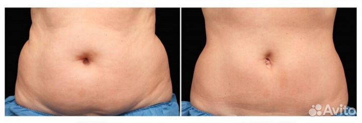 Вакуумно-роликовый массаж тела - дерматония