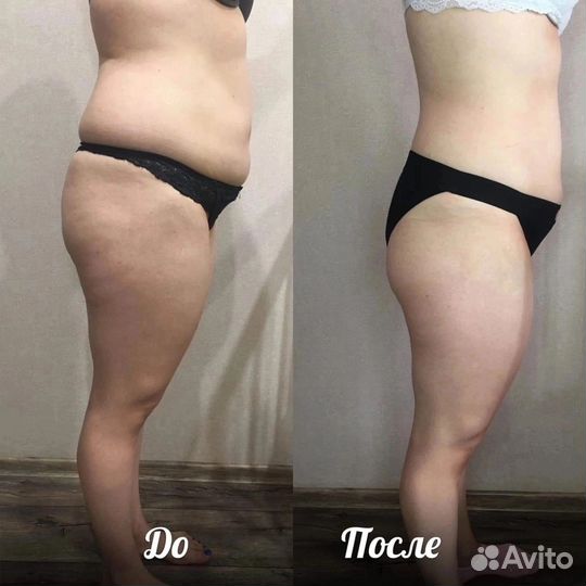 RET кавитация