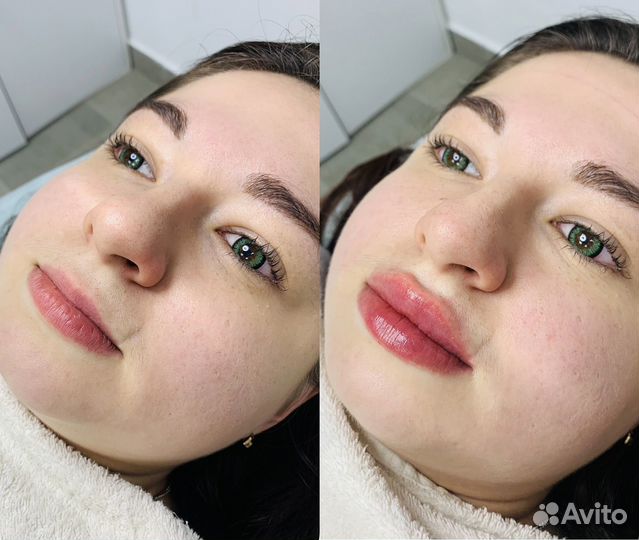Увеличение губ