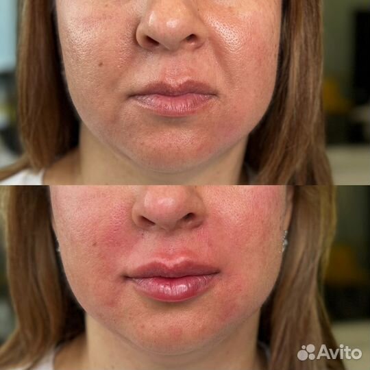 Коррекция носогубных складок