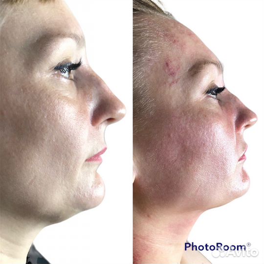 Скульптурный массаж лица