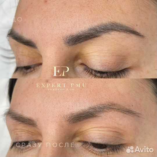 Аппарат Лазер для удаления тату ND Yag Beta