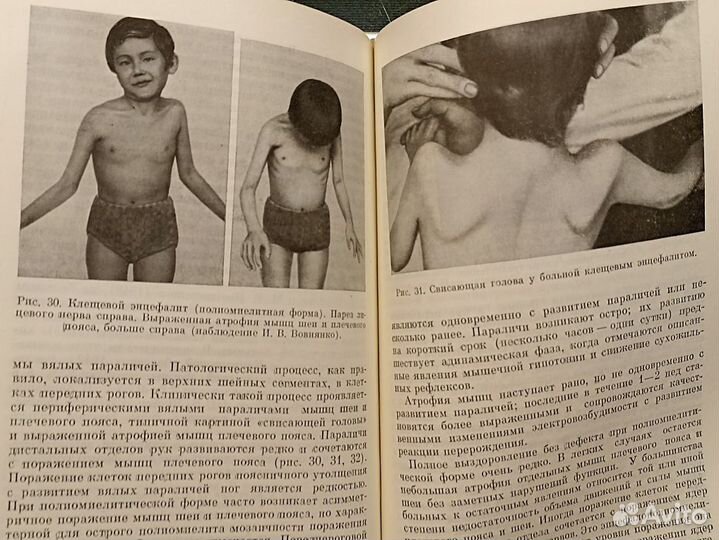 Менингиты и энцефалиты у детей. Цукер. 1975