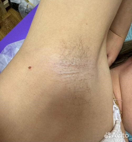 Депиляция / шугаринг