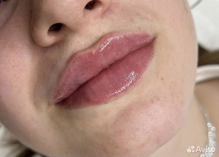 Модель на контурную пластику губ
