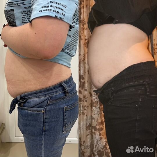 Криолиполиз (Похудение)