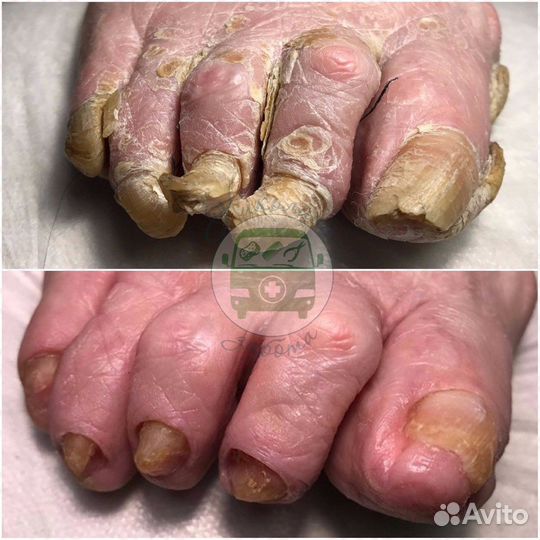 Парамедицинский педикюр пожилым с выездом на дом