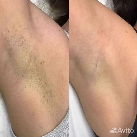 Франшиза студии лазерной эпиляции: успешный старт