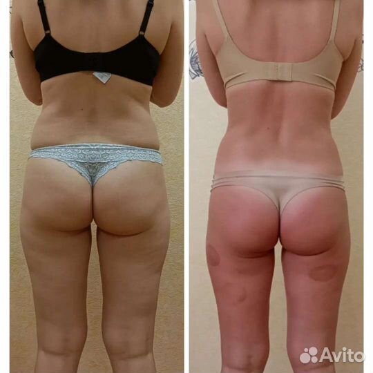 Антицеллюлитный, фитобочка, аппаратный