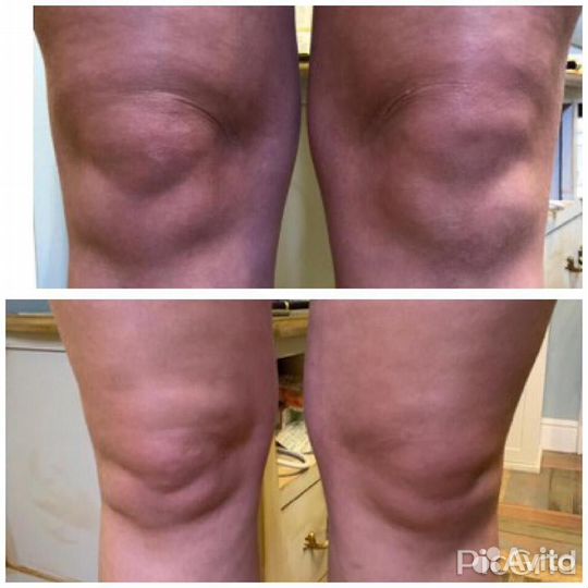 Биоревитализация