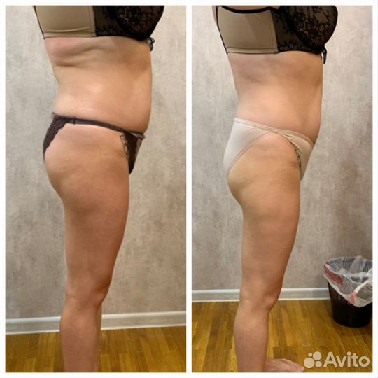 Антицеллюлитный массаж