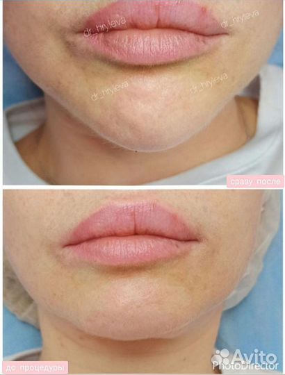 Инъекции ботокса в лоб