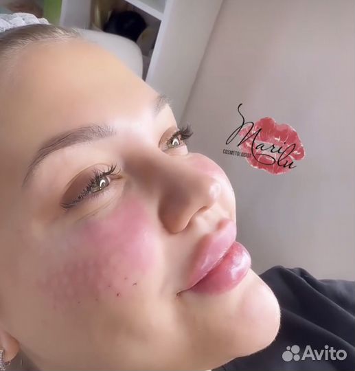 Увеличение губ