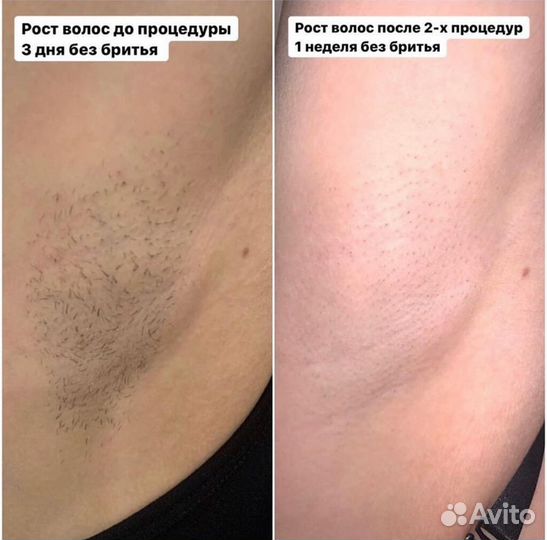 Лазерная эпиляция: глубокое бикини