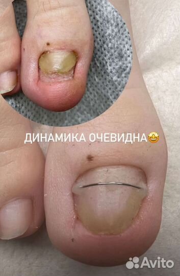 Подологический педикюр гпз/центр