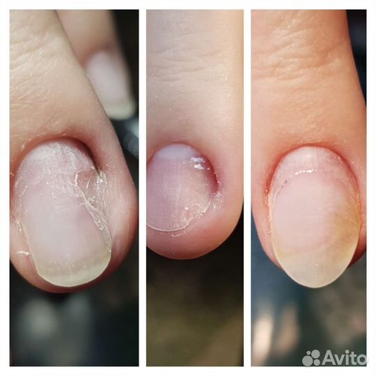 Подолог. Педикюр.лечебный педикюр. Сложные стопы