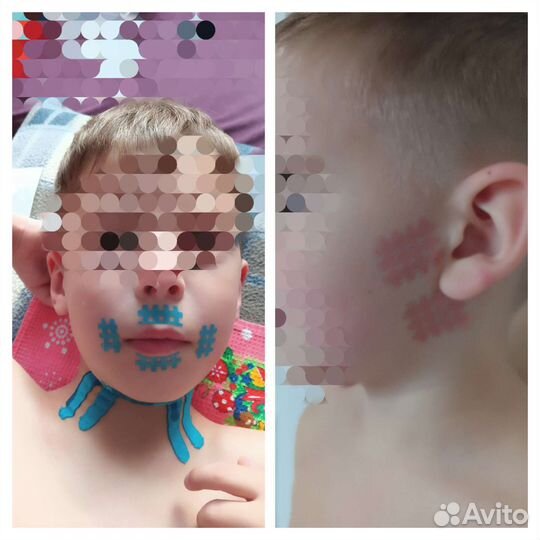 Логопедический массаж. логотейпирование