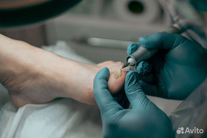 Медицинский (лечебный) педикюр - Подолог