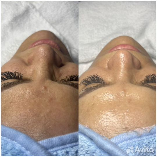 Чистка лица, маски, пилинг, hydrafacial