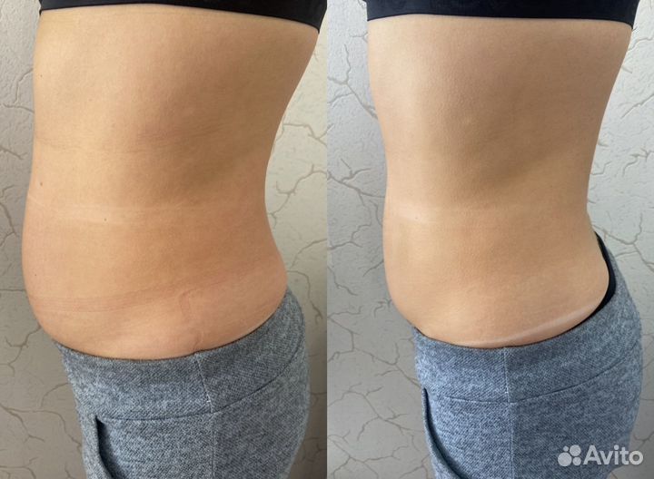 Липосоникс liposonix