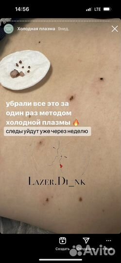 Лазерная эпиляци, холодная плазма, массаж