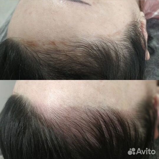 Трихопигментация (SMP) нужны модели