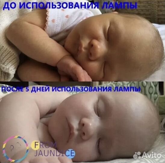 Лампа для лечения желтушки