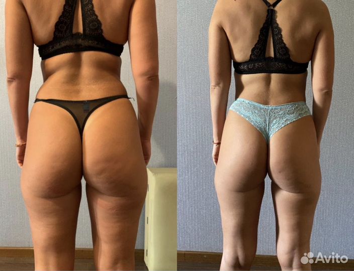 Антицеллюлитный массаж, массаж лица. Эффект сразу