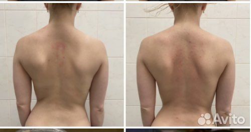 Массаж при сколиозе и искривлени позвоноч отдела