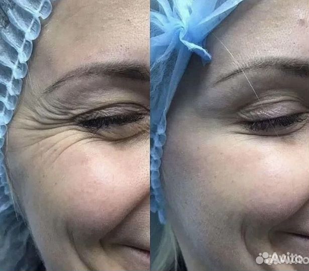 Врач косметолог услуги. Ботокс, филлеры