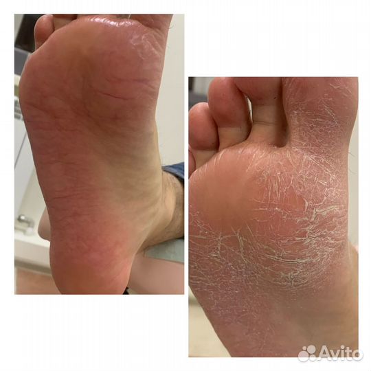 Педикюр медицинский, эстетический.Подология