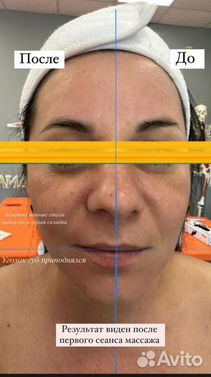 Буккальный массаж лица