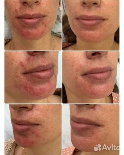 Карбокситерапия (газовые уколы)