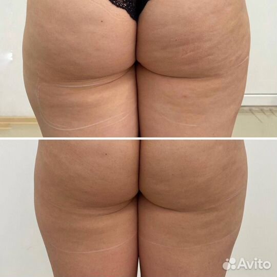 Коррекция фигуры, LPG массаж, RF лифтинг