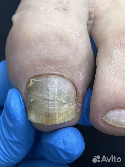 Подолог, медицинский педикюр, педикюр