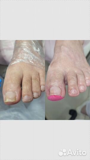 Педикюр подолог