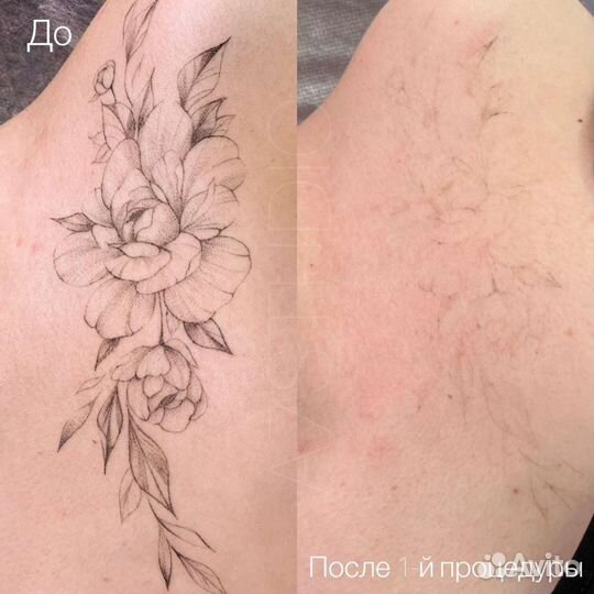 Удаление Татуировок Татуажа