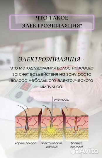 Электроэпиляция