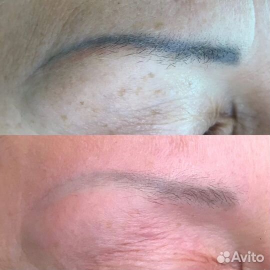 Удаление татуажа бровей, губ, татуировок