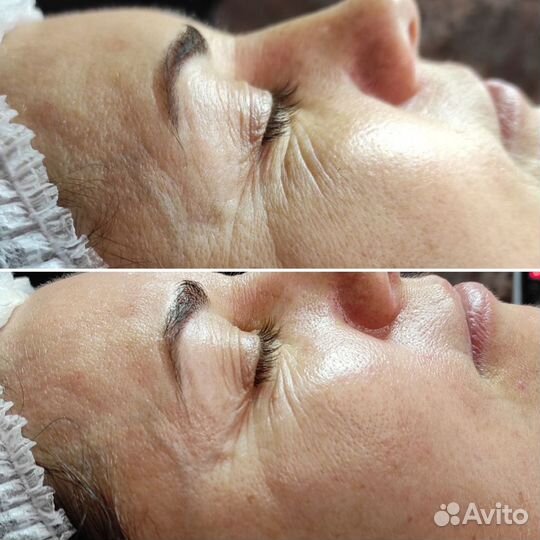 Сахарное моделирование фигуры и лифтинг лица