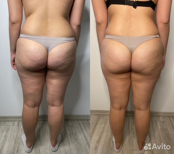 Антицеллюлитный массаж