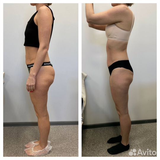 LPG массаж с результатом