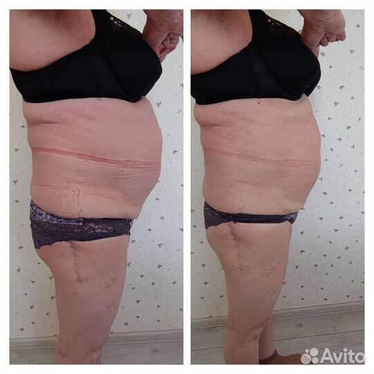 Вакуумный аппаратный массаж, кавитация, Rf-лифтинг