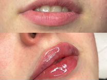 Увеличение губ,коррекция, контурная пластика губ