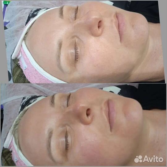 Механическая чистка лица