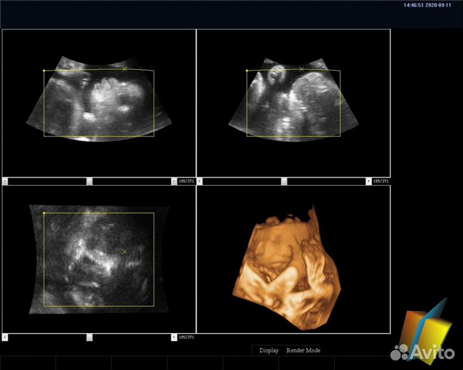 Узи аппарат